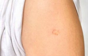 Vacina BCG é conhecida por deixar uma cicatriz no local de aplicação. (Foto: Reprodução) 